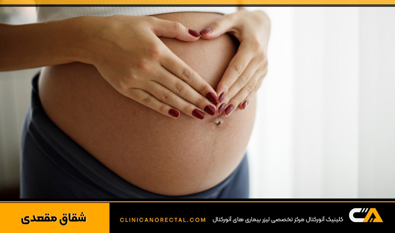 درمان فیشر در بارداری